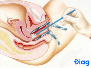 Colposcopy procedure for evaluating abnormal Pap smear results