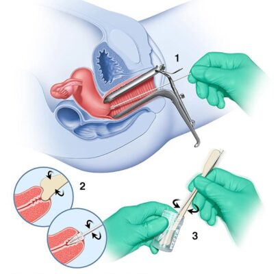 Abnormal Pap smear result — cervical cytology showing CIN changes requiring follow-up