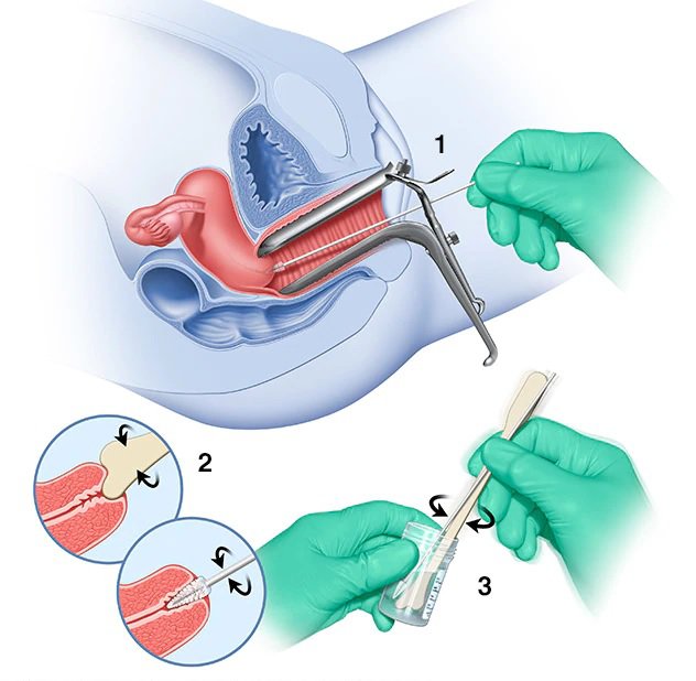 Abnormal Pap smear result — cervical cytology showing CIN changes requiring follow-up