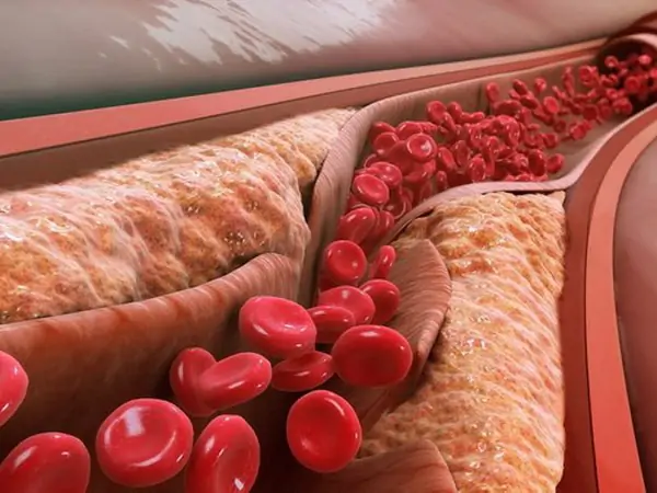 Cross-section of an artery showing atherosclerotic plaque buildup stages from early fatty streak to advanced lesion