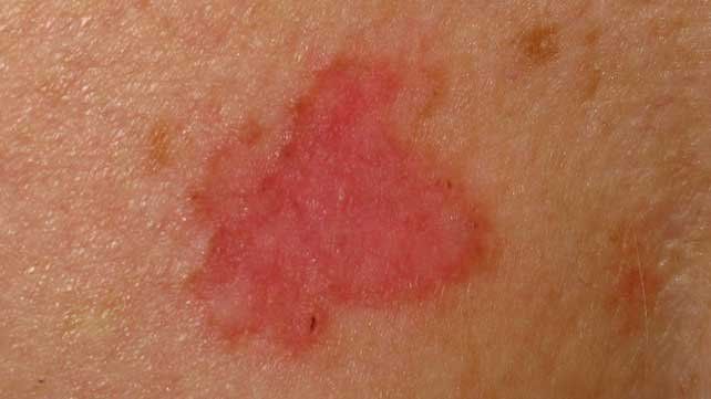 Basal cell carcinoma on facial skin showing treatment and excision