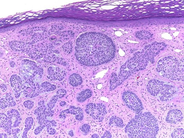 Basal cell carcinoma nodular type showing pearly papule with telangiectasias