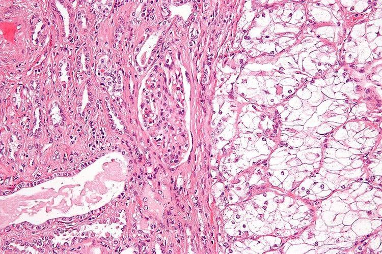 biopsy for cancer procedure needle tissue sample laboratory
