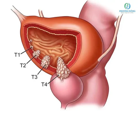 bladder cancer — urothelial carcinoma tumor growing inside the bladder wall, the most common type of bladder cancer
