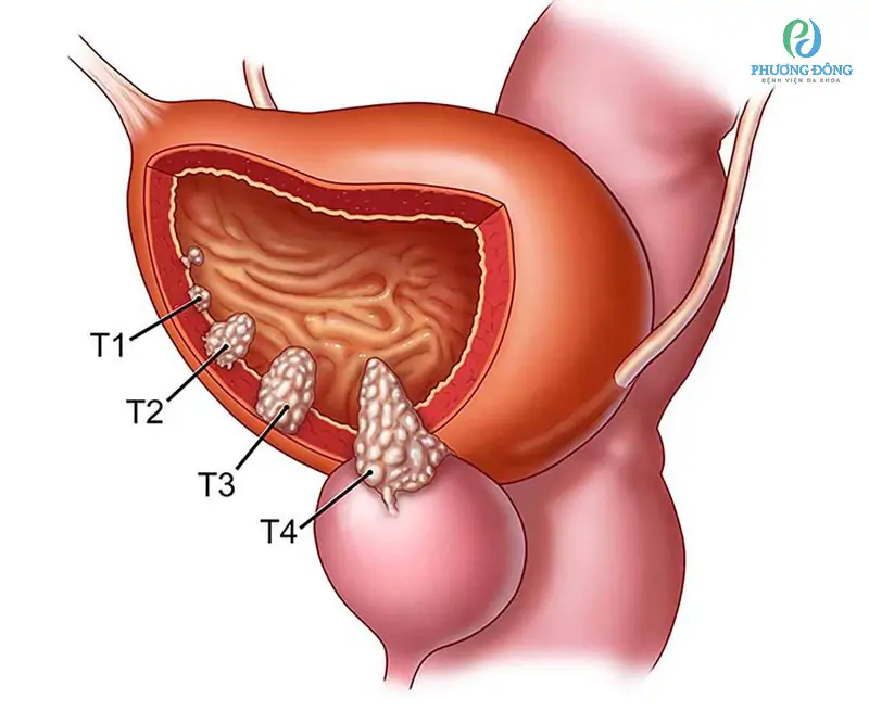 bladder cancer — urothelial carcinoma tumor growing inside the bladder wall, the most common type of bladder cancer