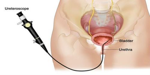painless hematuria — blood in urine — the most common and important bladder cancer symptom requiring immediate evaluation