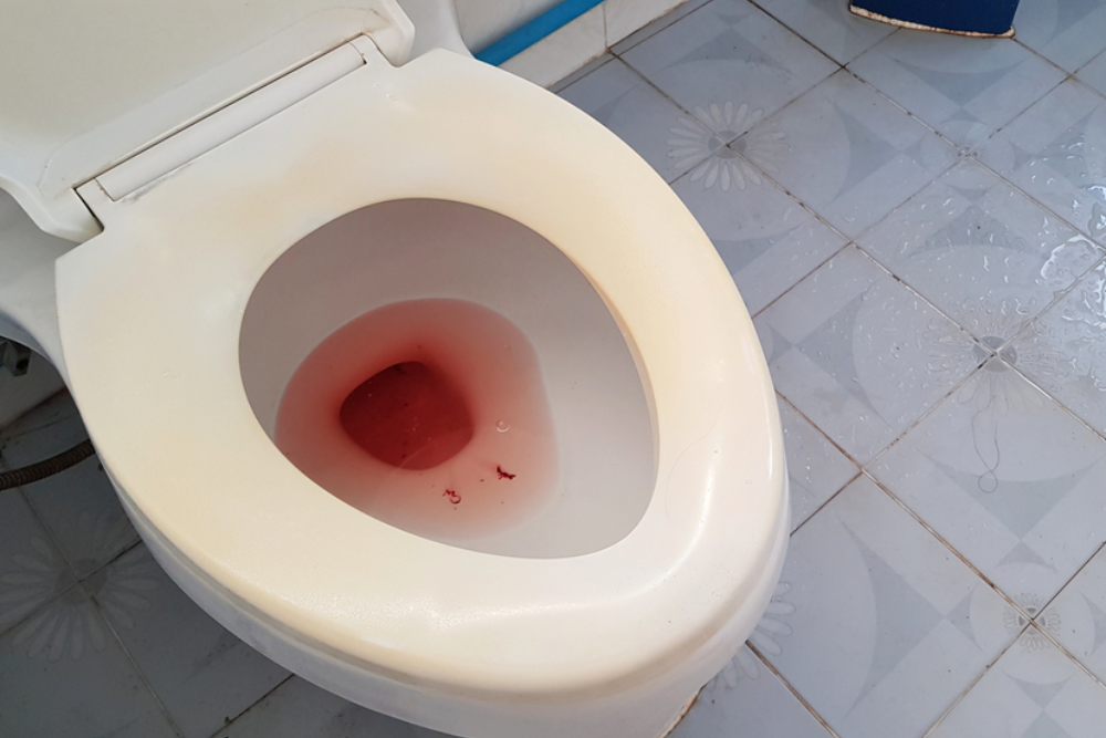 bladder cancer symptoms — hematuria, urinary urgency, and flank pain as the primary warning signs of bladder cancer