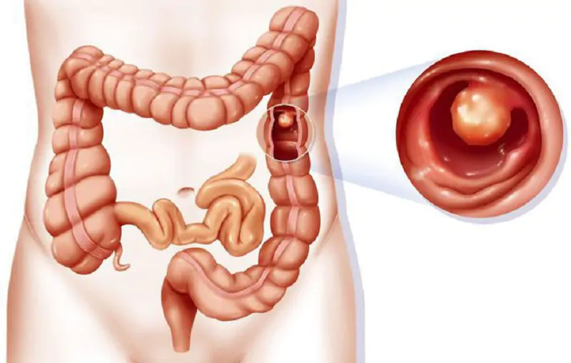 Diagram showing left colon versus right colon cancer bleeding patterns