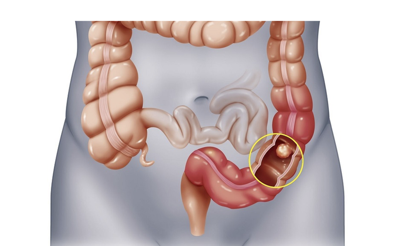 Warning signs of colon cancer including blood in stool requiring medical evaluation