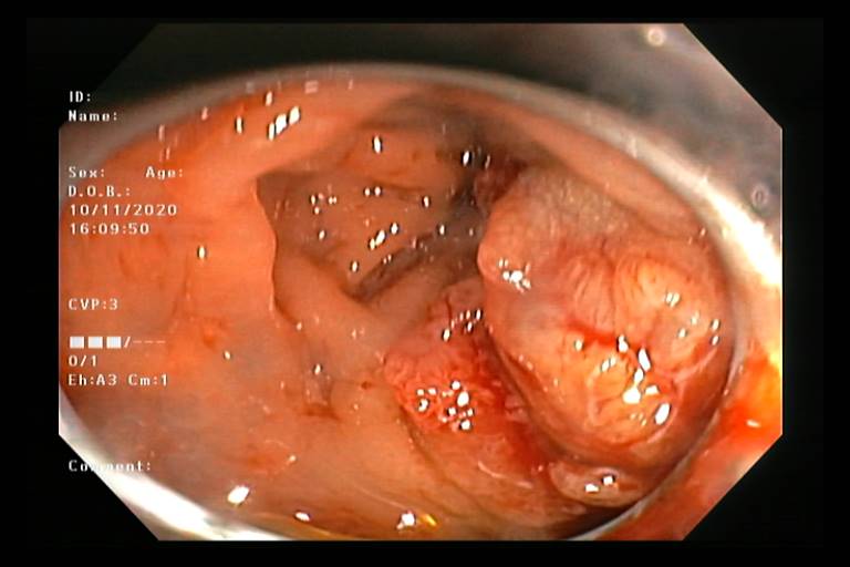 Colorectal cancer — the third most common cancer — frequently presents with rectal bleeding that is mistakenly attributed to hemorrhoids