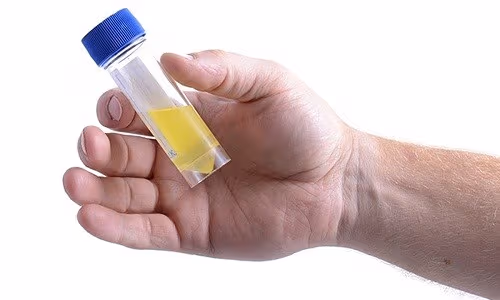 Blood in Urine and Cancer: What Hematuria Means and When It Is Serious