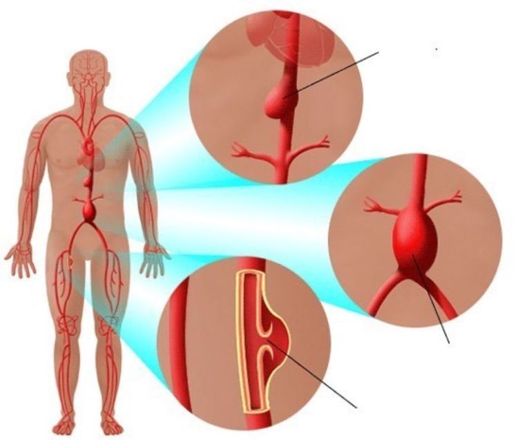 Blood pressure reading on a digital monitor showing systolic and diastolic numbers in millimeters of mercury