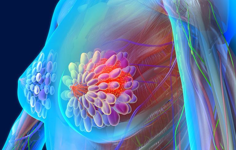 breast cancer awareness and treatment overview