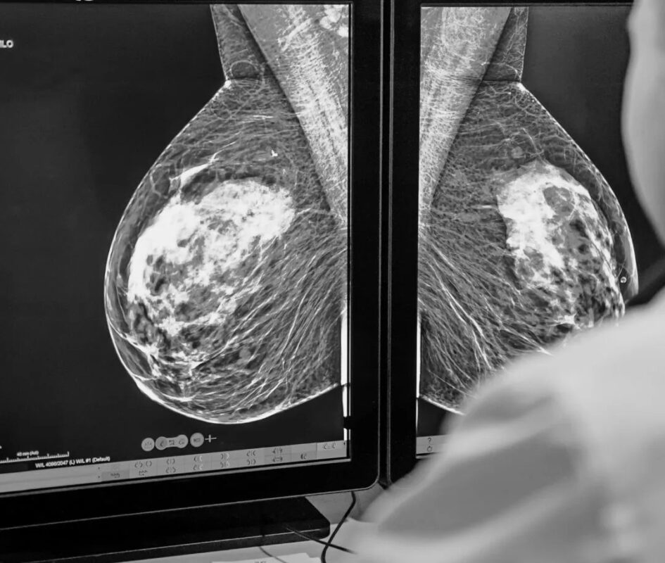 breast cancer screening mammogram guidelines women