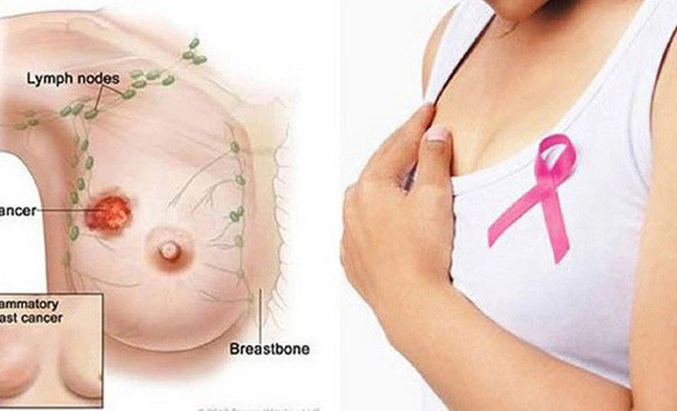 breast cancer symptoms nipple discharge inversion clinical exam
