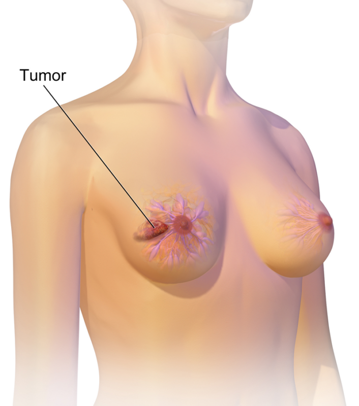breast cancer symptoms warning signs in women