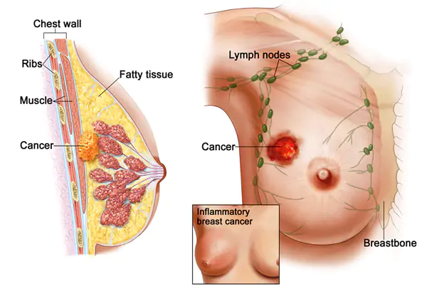 breast lump characteristics suspicious features evaluation