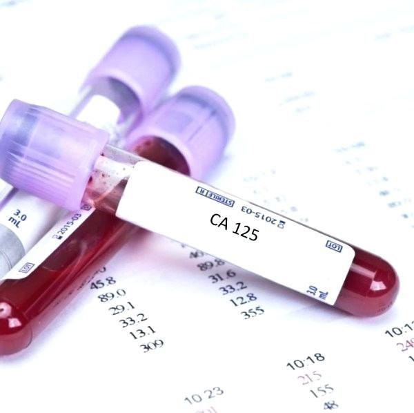 CA-125 normal levels chart — showing normal range below 35 U/mL and causes of elevated CA-125 in both cancer and benign conditions