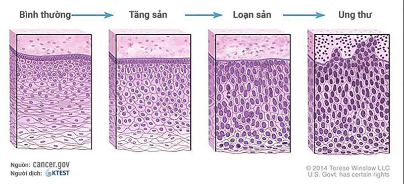 Cancer grade pathology slide showing cancer cell differentiation graded under microscope