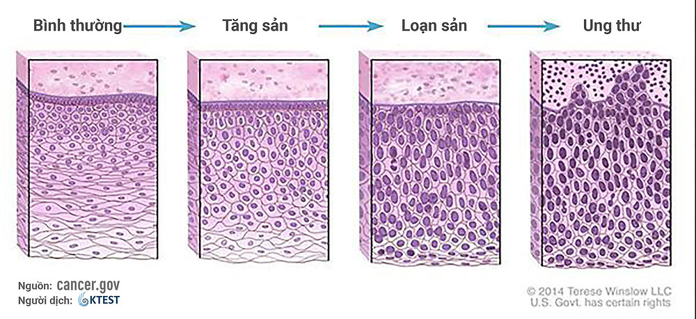 Cancer grade pathology slide showing cancer cell differentiation graded under microscope