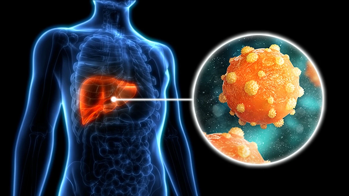 Hepatitis B virus (HBV) infecting liver cells, illustrating infection-driven inflammation and hepatocellular carcinoma risk