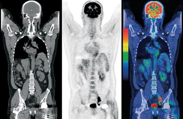 cancer monitoring PET-CT scan imaging tracks tumor response and recurrence