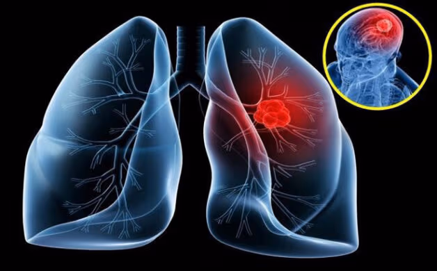 cancer prognosis guide survival statistics