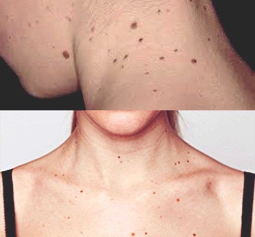 Dermatologist examining a mole for ABCDE melanoma warning signs including asymmetry, border, color, diameter, and evolution