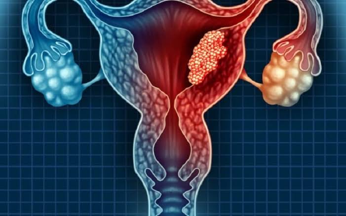 Cervical cancer screening Pap smear and HPV test for prevention