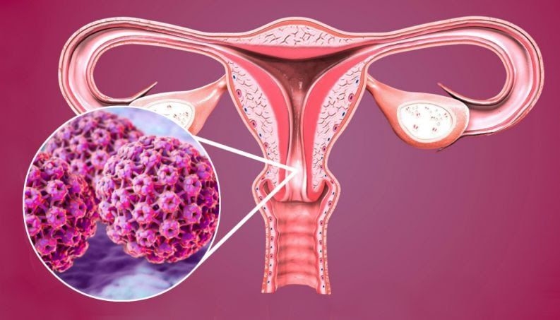 Cervical cancer caused by HPV — diagram of HPV infection and cervical cell changes