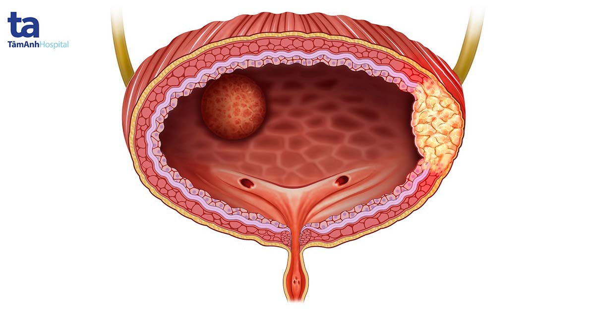 Bladder cancer — the fourth most common cancer in men — often presents with irritative urinary symptoms mistakenly treated as recurring UTIs
