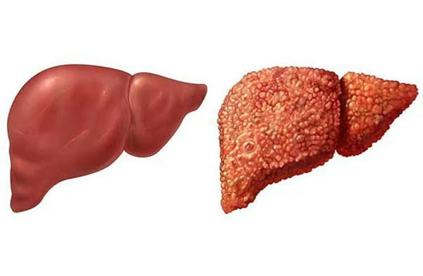 cirrhosis and liver cancer — fibrous scar tissue replacing normal liver architecture creating conditions for hepatocellular carcinoma