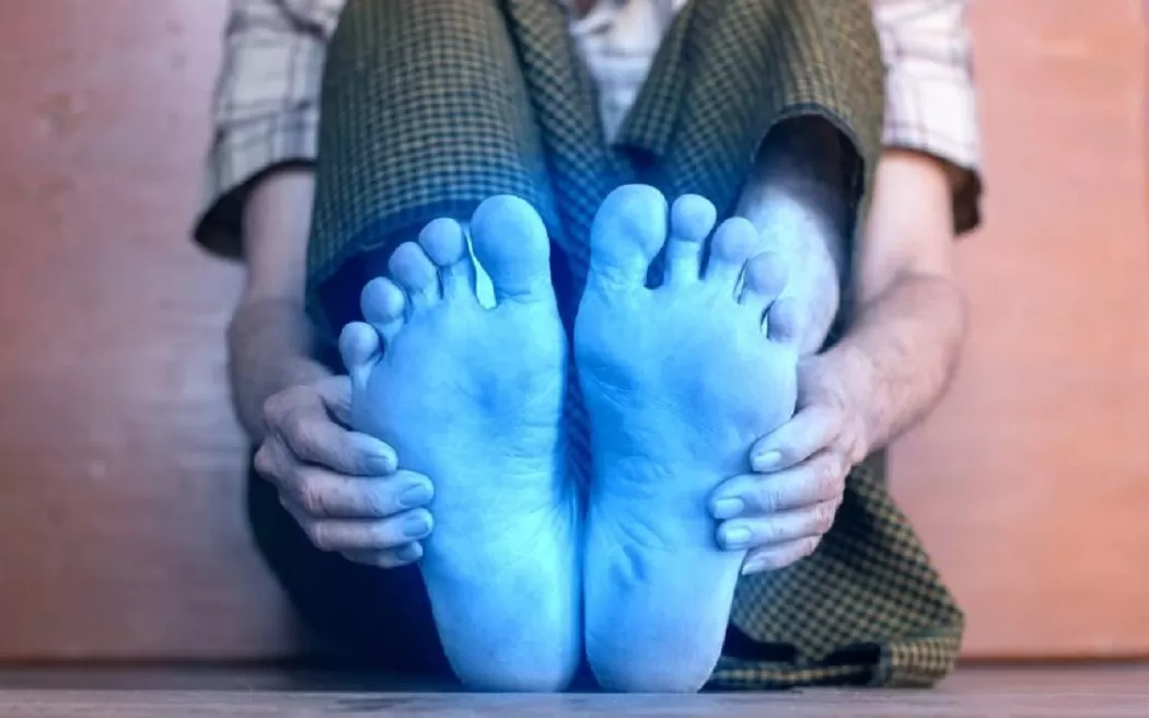 cold hands and feet circulation causes Raynaud's phenomenon color changes
