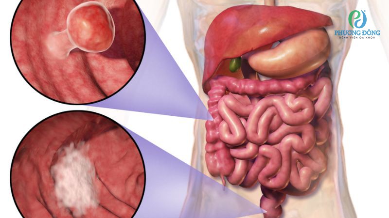 colon cancer staging diagram showing tumor location in the large intestine