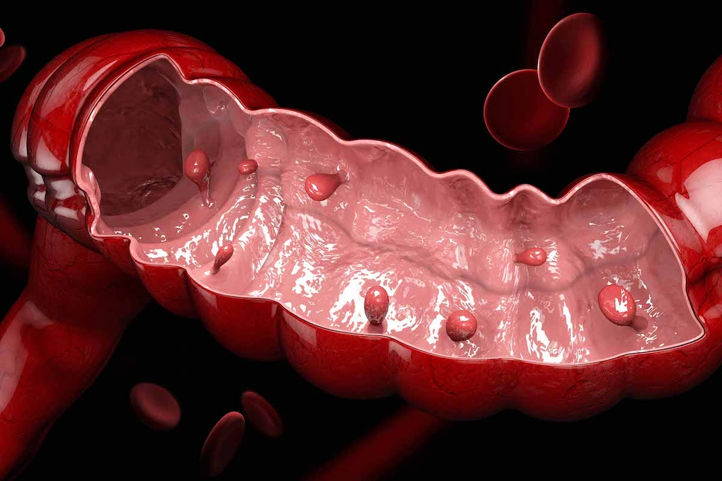 colon polyp adenoma showing the polyp to cancer pathway