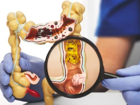 colon cancer symptoms illustration showing the large intestine