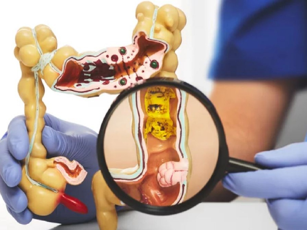 colon cancer symptoms illustration showing the large intestine