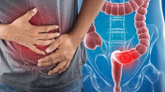 diagram of colorectal cancer location in the colon and rectum