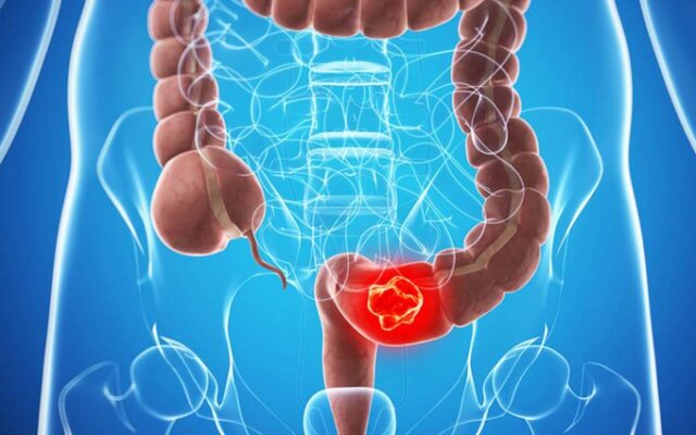 colorectal cancer illustration showing colon anatomy