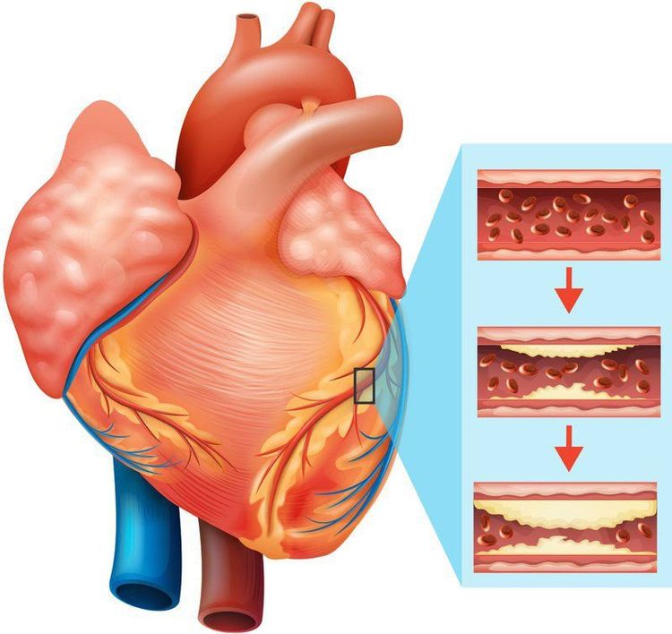 Diagram comparing a normal coronary artery to one narrowed by atherosclerotic plaque in coronary artery disease