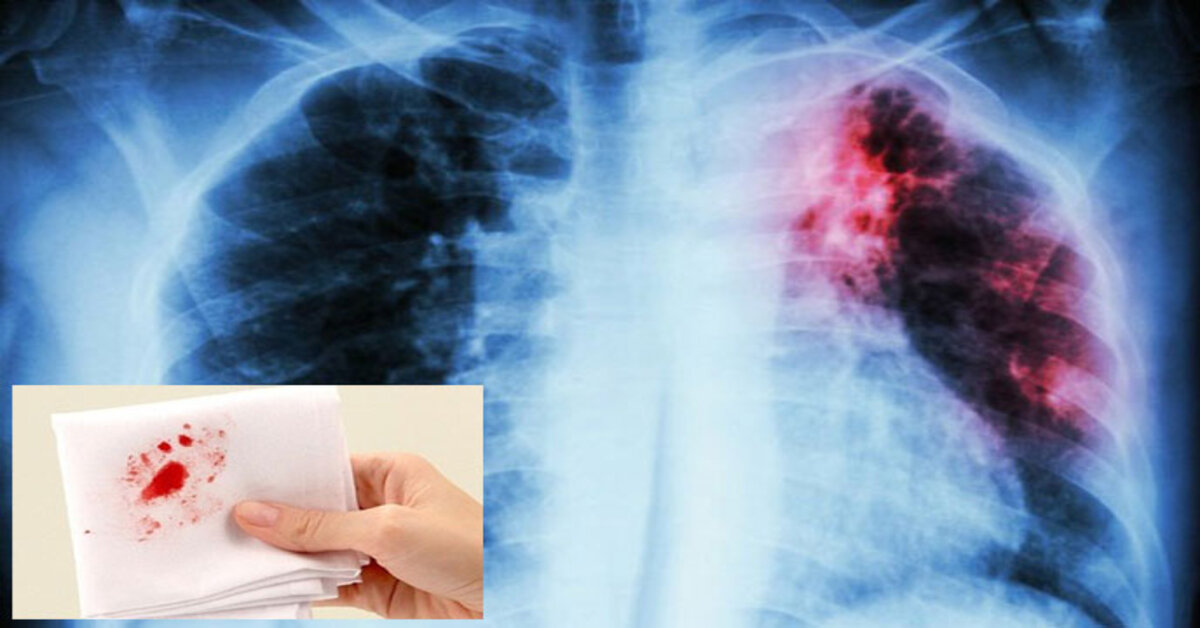 coughing blood lung cancer hemoptysis warning sign
