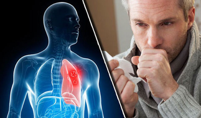 coughing blood lung cancer bronchial artery erosion mechanism