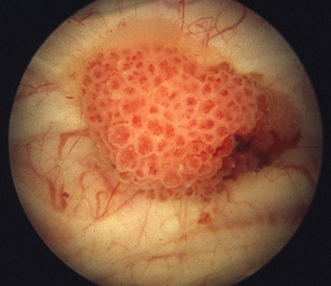 flexible cystoscopy instrument and bladder visualization — used for diagnosing bladder cancer and hematuria evaluation