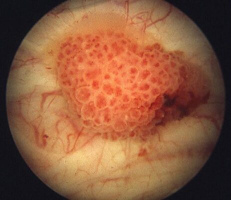 cystoscopy procedure — direct endoscopic visualization of the bladder interior for diagnosing bladder cancer and evaluating hematuria