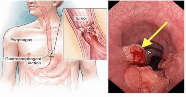 Difficulty swallowing cancer warning signs esophageal cancer symptoms progressive dysphagia evaluation
