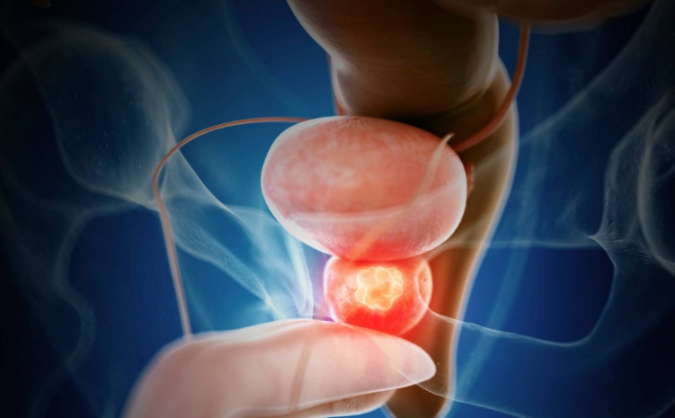 prostate anatomy diagram showing transition zone BPH and peripheral zone prostate cancer