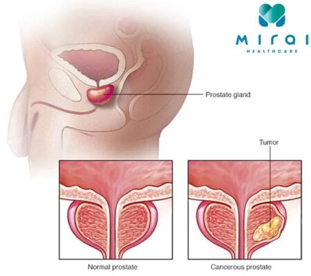 high PSA blood test prostate cancer evaluation