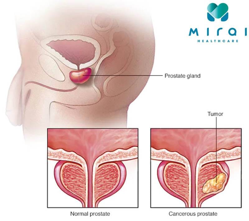 high PSA blood test prostate cancer evaluation