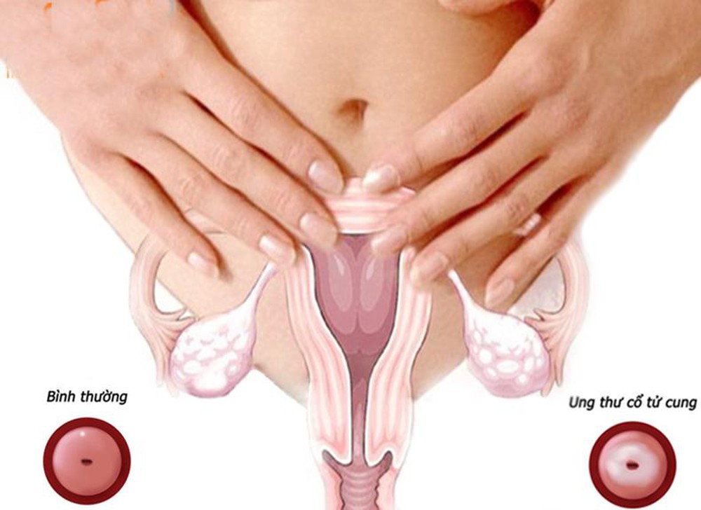 Cervical cancer development stages from HPV infection through CIN grades to invasive cancer
