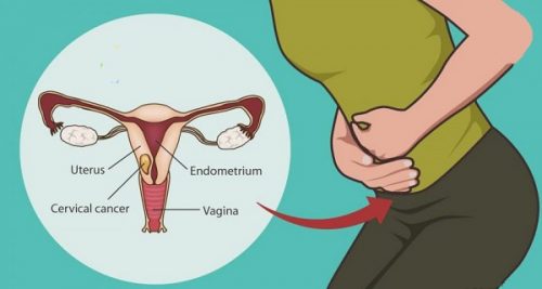 HPV and cervical cancer — how human papillomavirus causes cervical malignancy